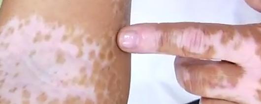 Manchas sem pigmentação na pele? Pode ser vitiligo