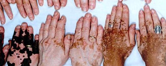 25.06: SBD/MS conscientiza a população no dia Mundial do Vitiligo